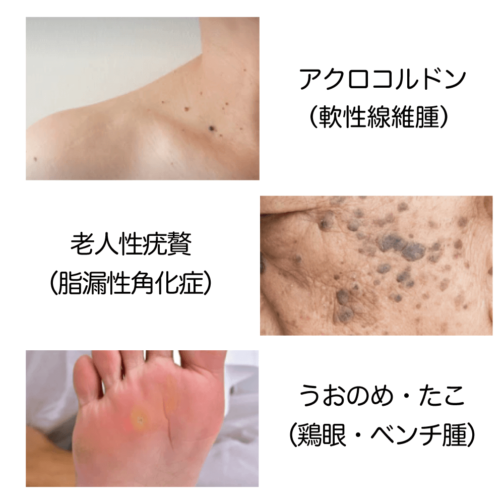 ウイルス性疣贅（イボ） - 自由が丘・奥沢の皮膚科・美容皮膚科【M