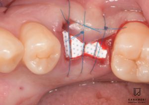 歯を抜く前にご相談を ソケットプリザベーション 抜歯窩保存術 : 品川