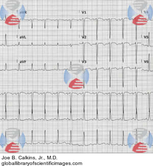 Figure 2 Reversal of all Precordial Leads | Global Library of