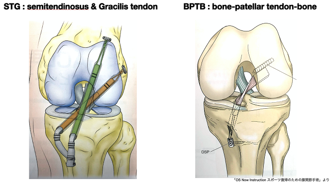 前十字靭帯損傷の治療 | 堀江病院