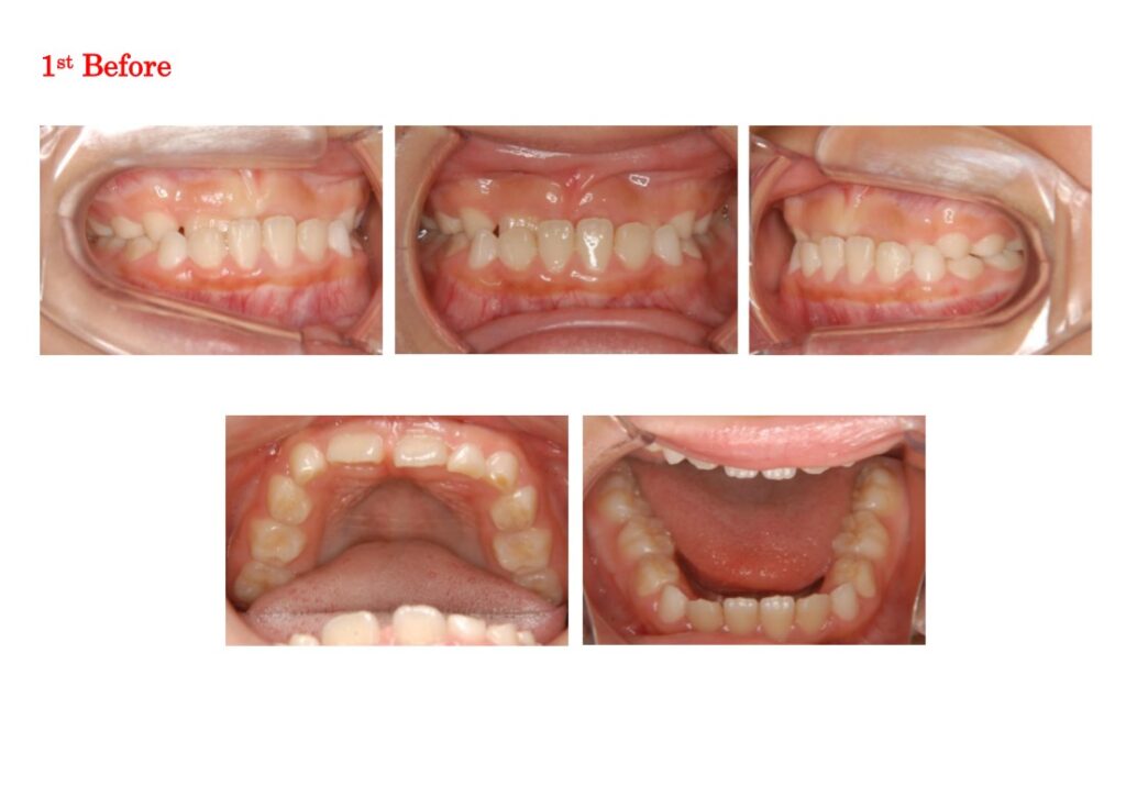 Case：反対咬合＋先天性欠如（1本） 非抜歯・2期分割治療 | 神保矯正歯科