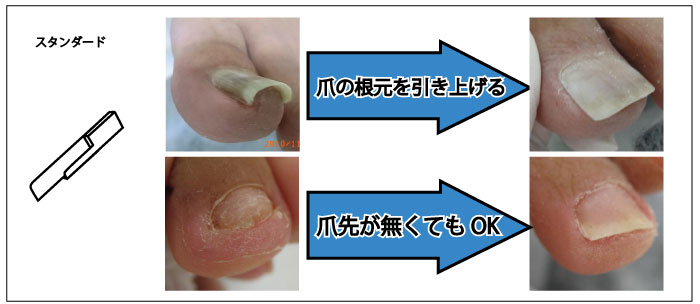 施術方法/巻き爪補正（巻き爪＆フットケアのペディグラス）