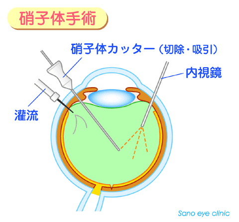 さの眼科: 硝子体手術