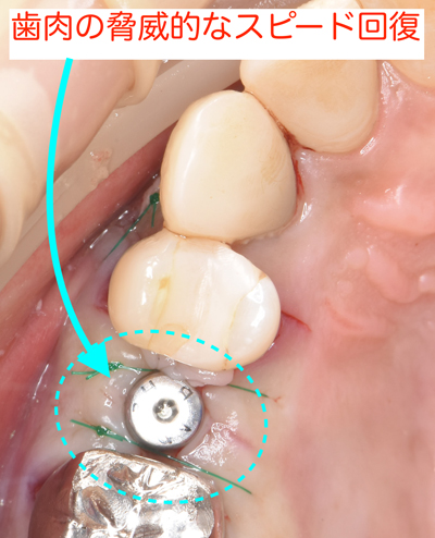 インプラント | ブルーラジカル歯周病治療 大阪 奈良 | Newスタイル