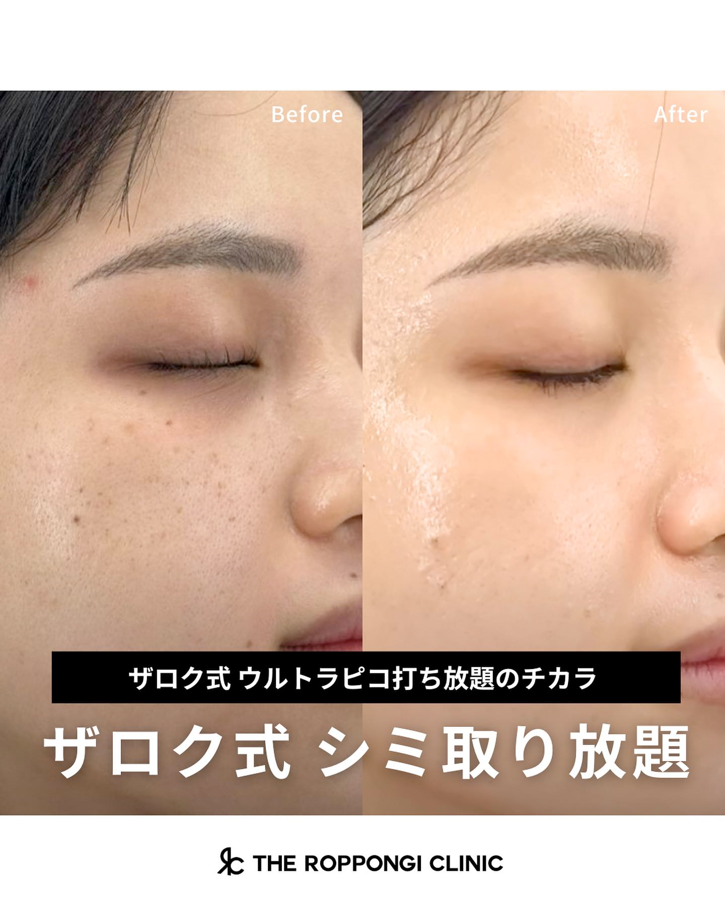 ザロク式ウルトラピコ打ち放題のチカラ】ザロク式シミ取り放題 の