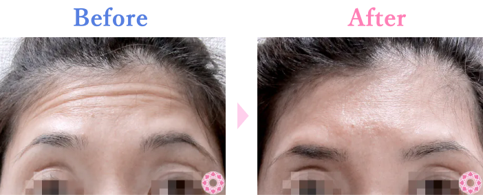 シワ取り（ボトックス）｜ボトックス｜美容整形のことなら東京形成美容