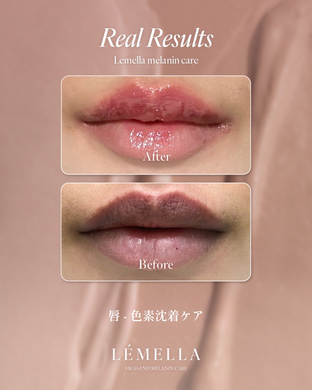 ルメラ（LEMELLA）メラニンケア｜豊橋の美容皮膚科 遠山クリニック