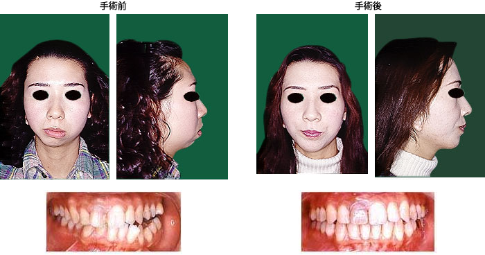 顎変形症の症例 | 鶴木クリニック医科・歯科鶴木クリニック医科・歯科