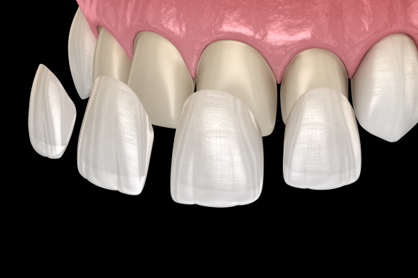 セラミック治療（白い歯） | 千葉県 柏市の歯医者「うらずみ歯科