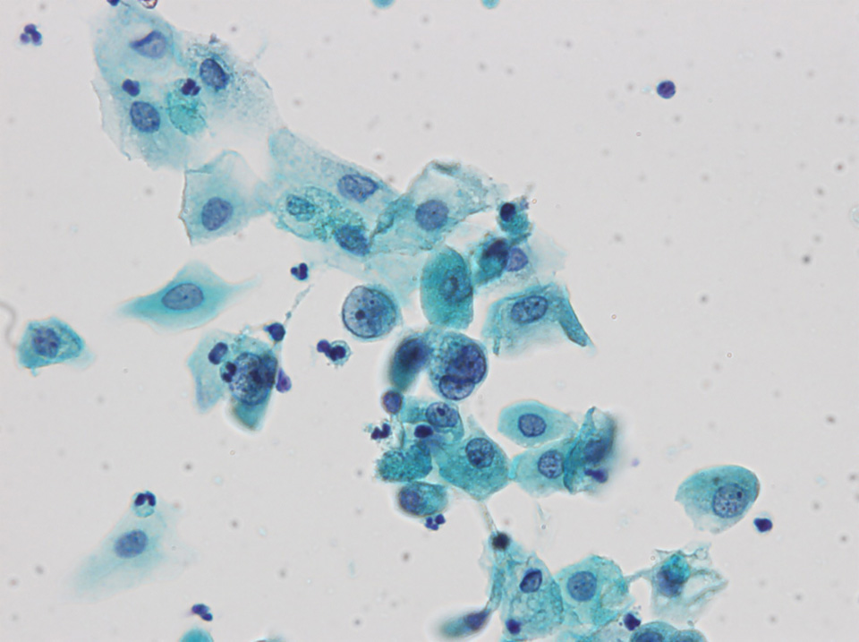 第17回 スライドカンファレンス症例 ｜ 泌尿器細胞診(別府)カンファレンス