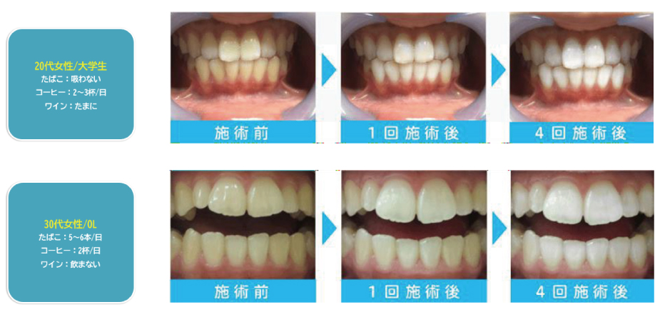美歯口ホワイトニング CHARION【シャリオン】