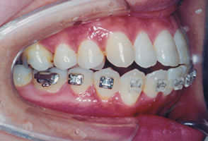 矯正の失敗-再治療が必要になった例【口コミ歯科・歯医者】