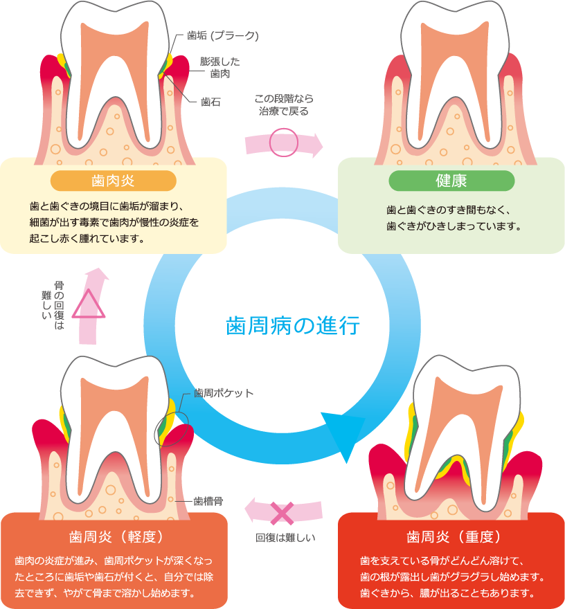 歯周病治療｜診療科目｜秋田市の歯医者・歯科医院ならクローバー