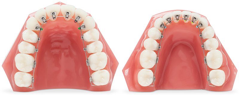 リンガルブラケット矯正装置（ALIAS（アリアス））｜赤羽矯正歯科