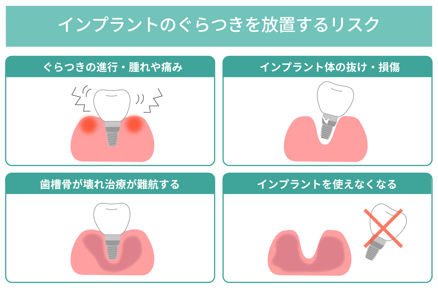インプラントのぐらつきは治るの？ 放置するリスクと原因別の治し方を