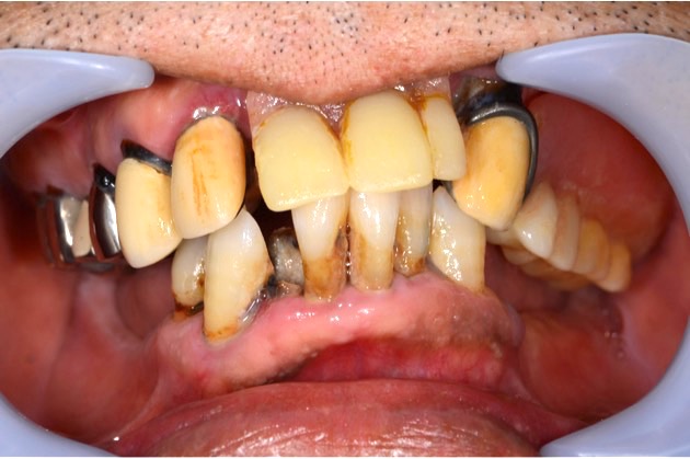 CASE04 インプラントを戦略的に利用し咬合再構成を行った症例 | 秋津の