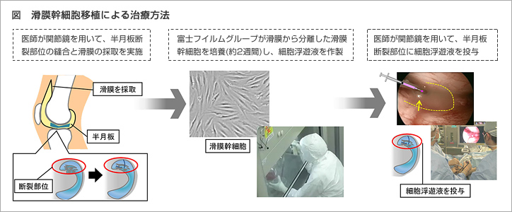 富士フイルムと東京医科歯科大学 半月板損傷を対象とした、世界初の