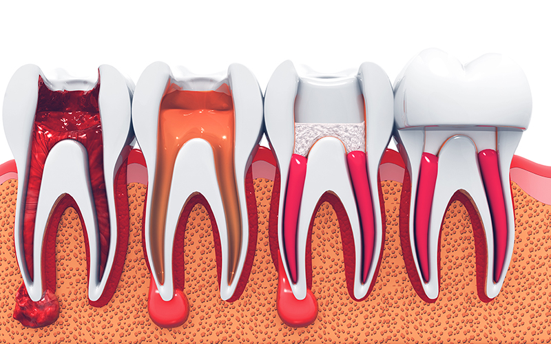 裁断済み】治癒の歯内療法 ENDODONTICS 裁断済み】治癒の歯内療法