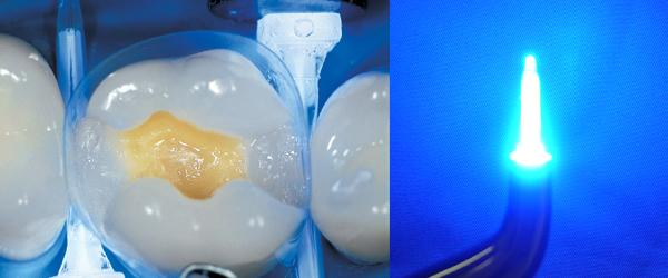 kerr,CR充填サポート製品,ルーシーウェッジ | エンビスタジャパン株式