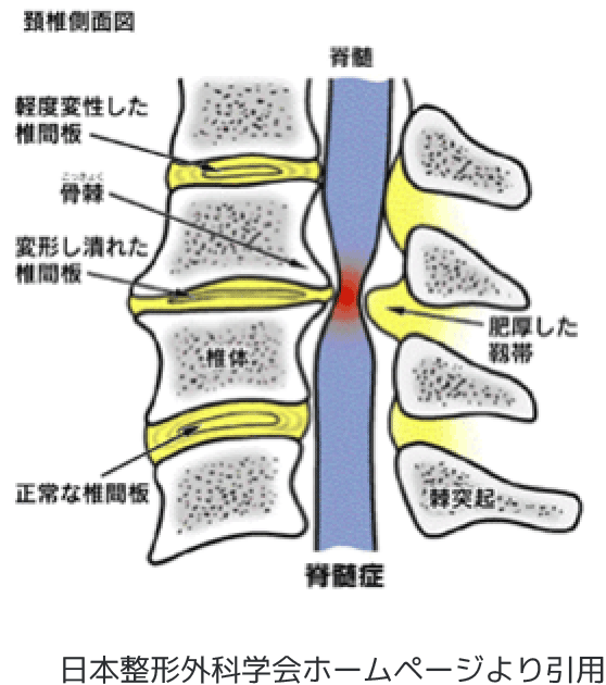頚椎・胸椎疾患：整形外科の専門手術 人工関節手術・関節鏡視下手術