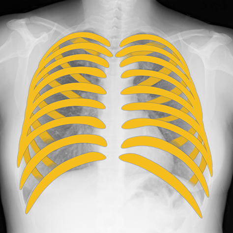 Bone Suppression処理（胸部骨減弱処理） | コニカミノルタ