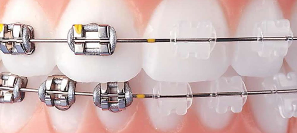白いブラケットを使用した矯正 | 千葉県柏市で歯列矯正なら柏KT矯正歯科