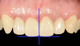 審美補綴による治療 | 稲沢市の歯医者【けやき通り歯科クリニック】