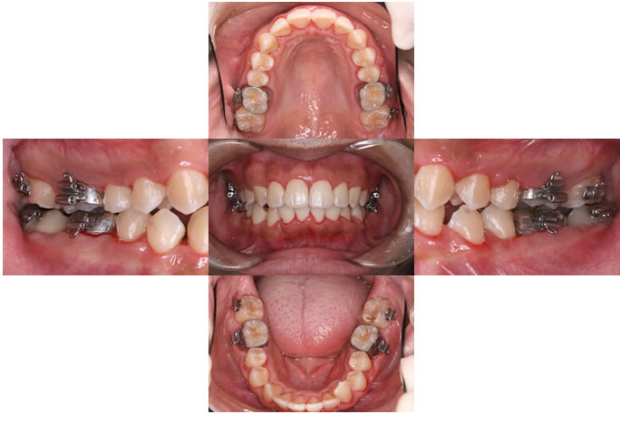 歯周矯正 GPがすべき五つの矯正治療 歯周矯正 GPがすべき五つの矯正