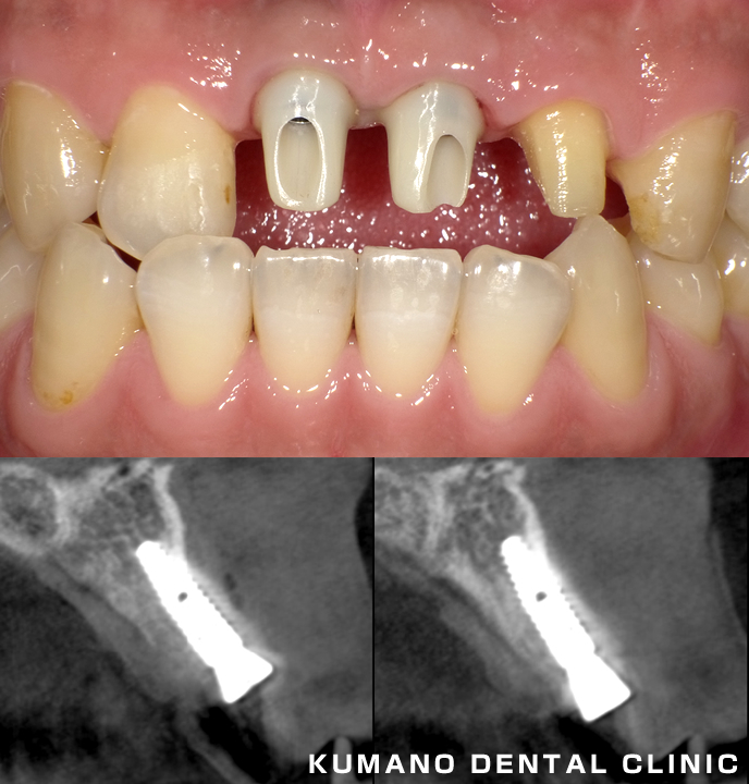 前歯部審美治療の症例01 - くまの歯科