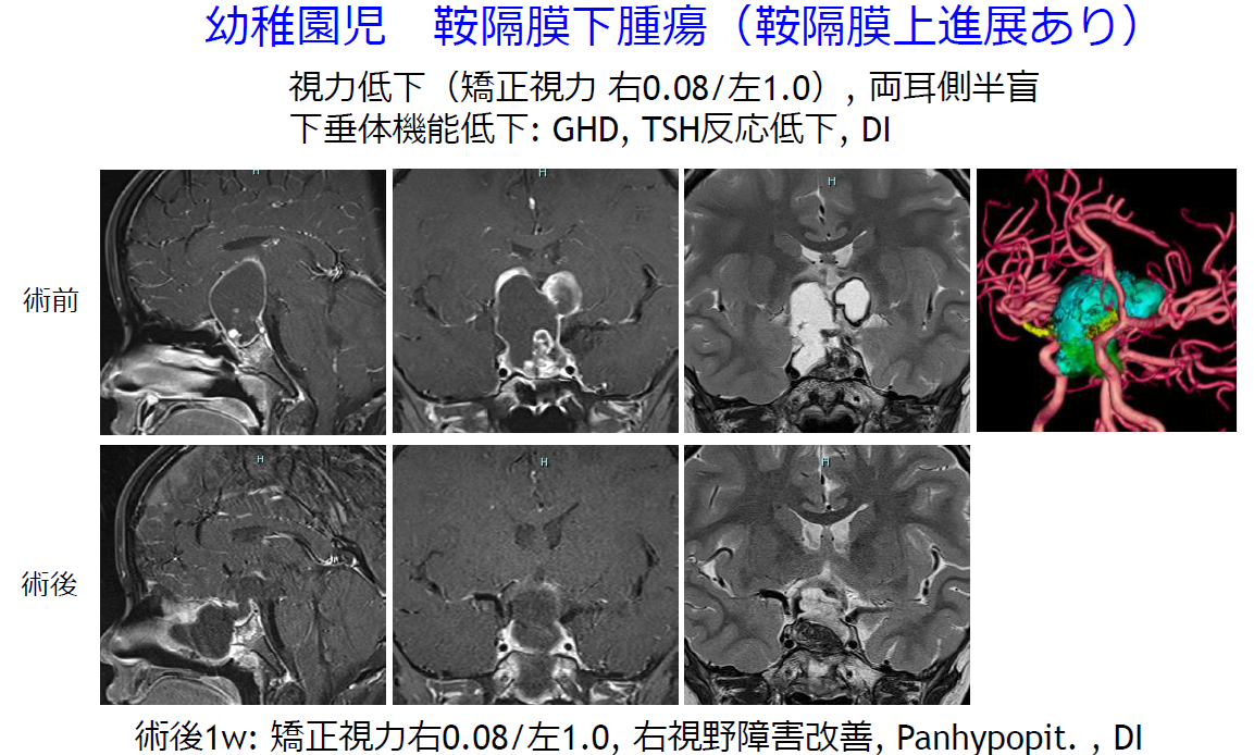 頭蓋底二刀流 阿久津義博教授 第10回かなたま集談会