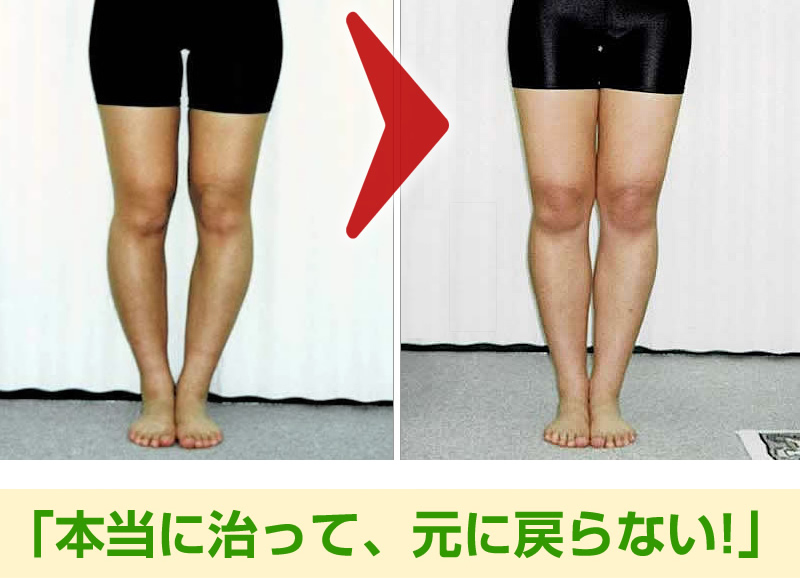 O脚・美脚矯正へのこだわり｜福岡市博多の整体・専門矯正の博多カイロ