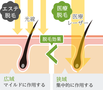 皮膚科医が解説】医療レーザー脱毛とエステ光脱毛はどっちがいい？違い