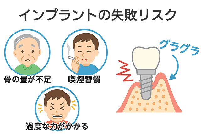 インプラント治療で注意すべきリスクや危険性は？安全に受けるにはどう