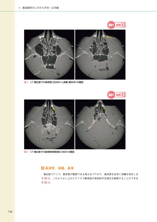 内視鏡下鼻副鼻腔・頭蓋底手術_CT読影と基本手技2e_立読み