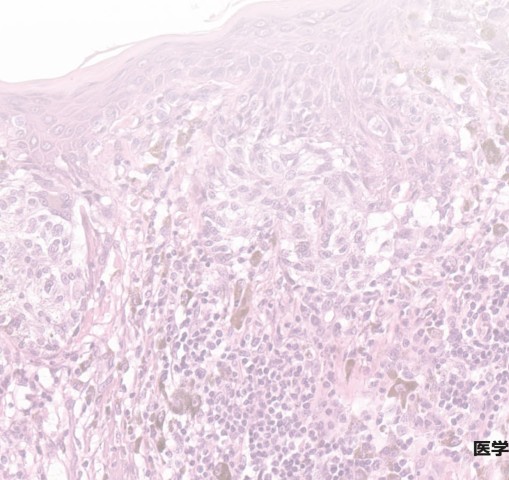 皮膚病理診断リファレンス_立読