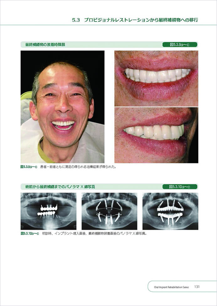 プロビジョナルレストレーション装着期間中の口腔周囲筋トレーニング
