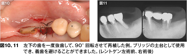 歯牙再植 - 歯とお口のことなら何でもわかる テーマパーク8020