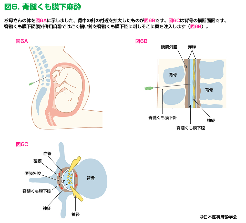 Q4. 脊髄くも膜下麻酔とはどのような方法ですか？ | 一般社団法人 日本