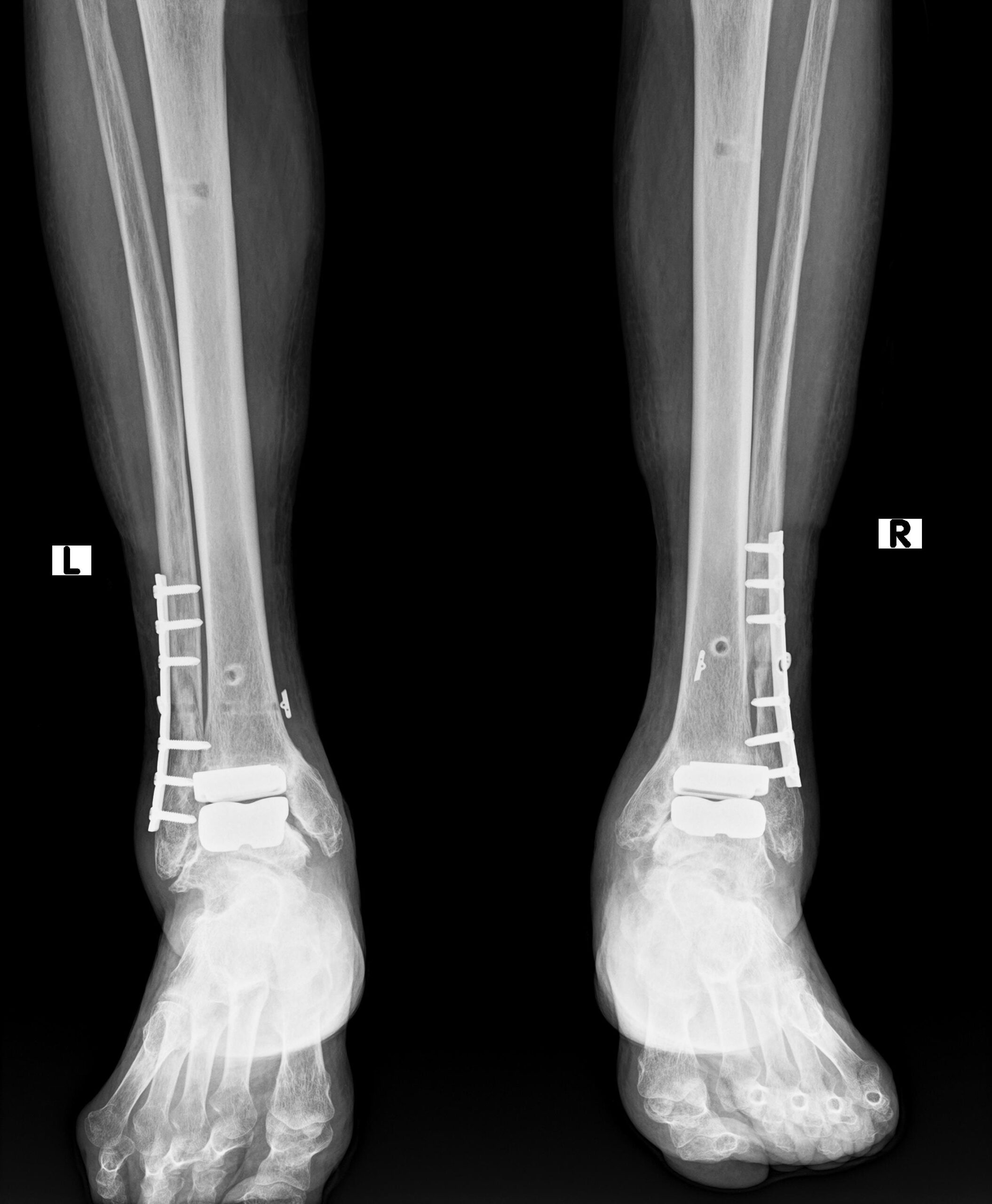 80代男性 両側同時人工足関節置換術 | 医療法人社団健友会 岡本整形