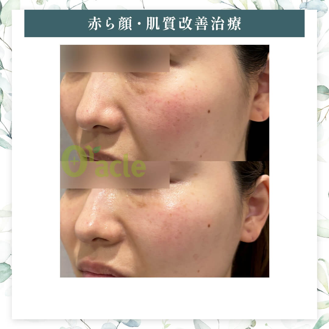 韓国のキャビア注射（ユースヒール）｜【公式】オラクル美容皮膚科