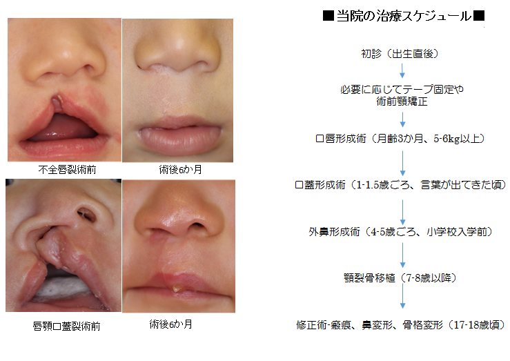 唇顎口蓋裂 | 形成外科 | 【公式】 大阪市立総合医療センター