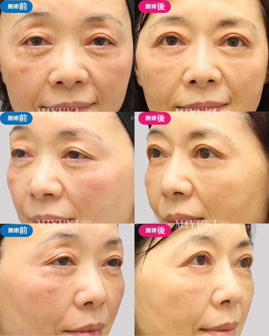 自然で若々しい目元へ～切開を取り入れたエイジングケアで、まぶたの