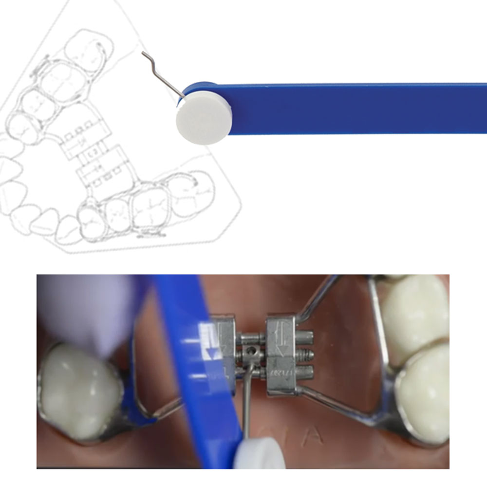The Original Swivel Key – Orthodontic Supply & Equipment Company
