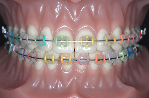 和歌山市でカラフルなブラケットを取り扱っている歯科医院-写真あり