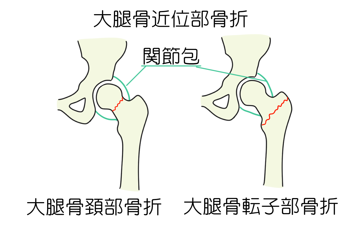 大腿骨近位部骨折について - 岐阜市 - 森整形外科リハビリクリニック