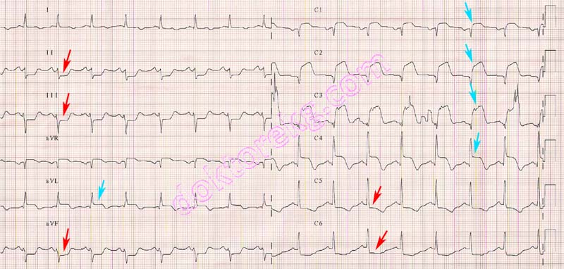 acute anterior myocardial infarction - akut ön duvar miyokard