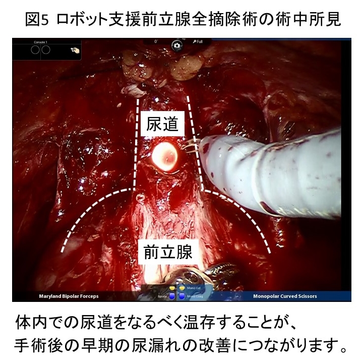 ロボット支援前立腺全摘除術｜福岡大学医学部腎泌尿器外科学講座