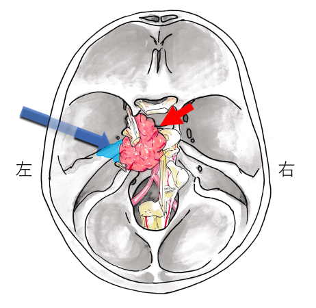 頭蓋底外科｜診療内容｜臨床｜神戸大学医学部附属病院 脳神経外科