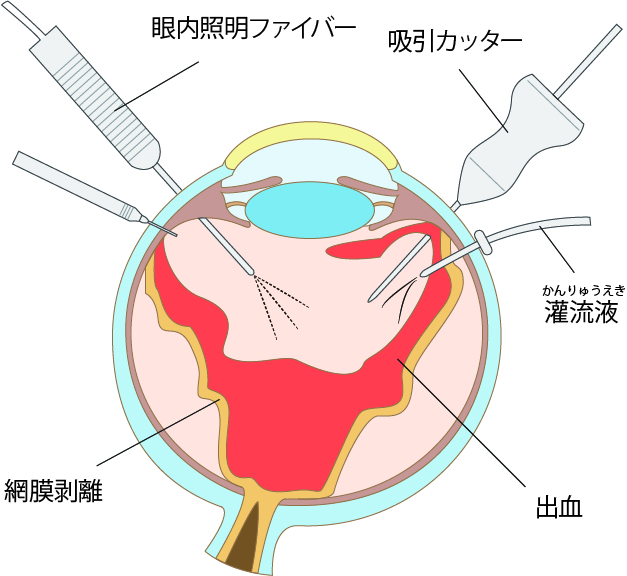 海老名市の日帰り網膜硝子体手術ならみたに眼科クリニックまで