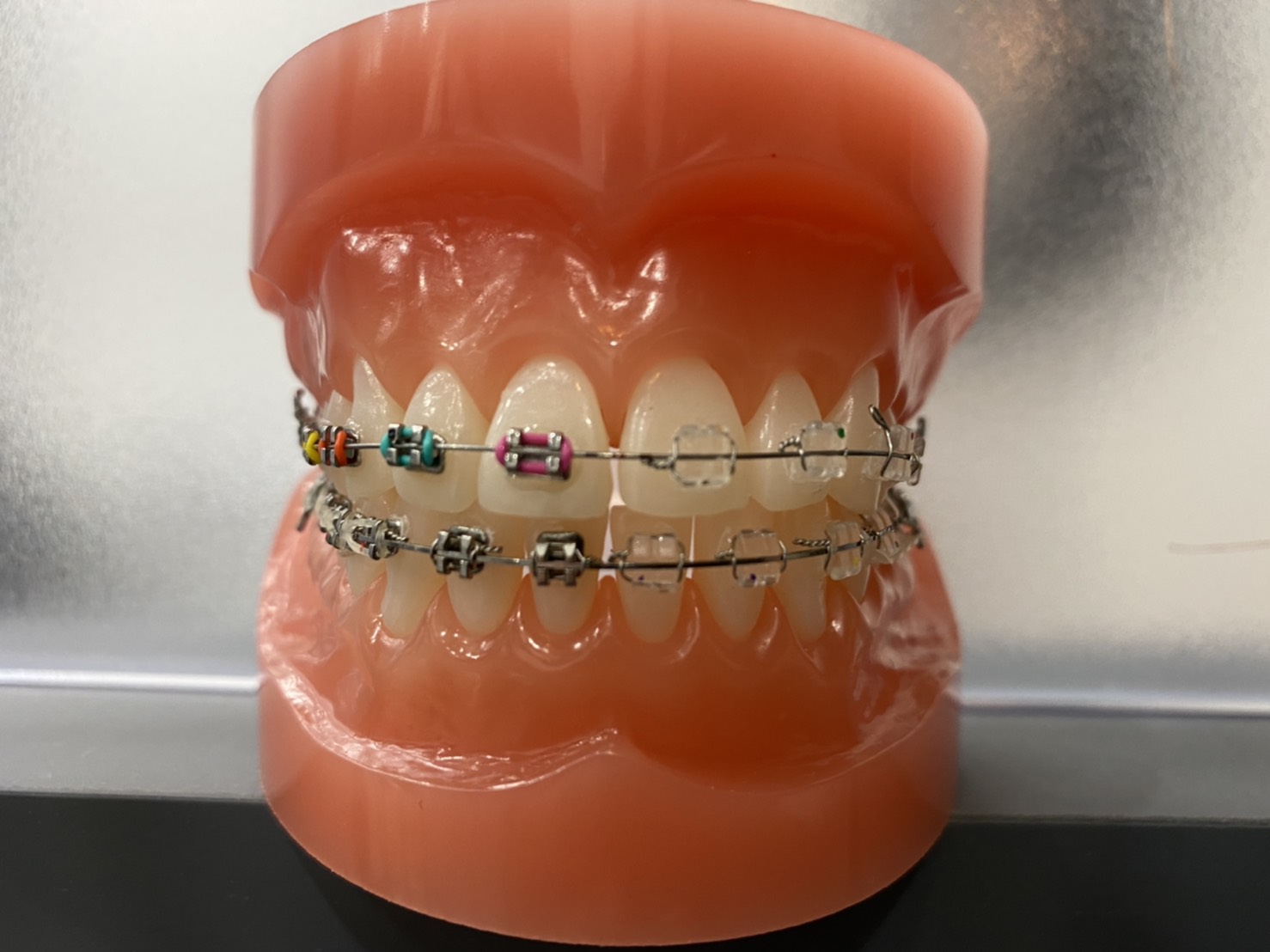 歯科矯正『ブラケット矯正』は目立つ | 三鷹miki矯正歯科